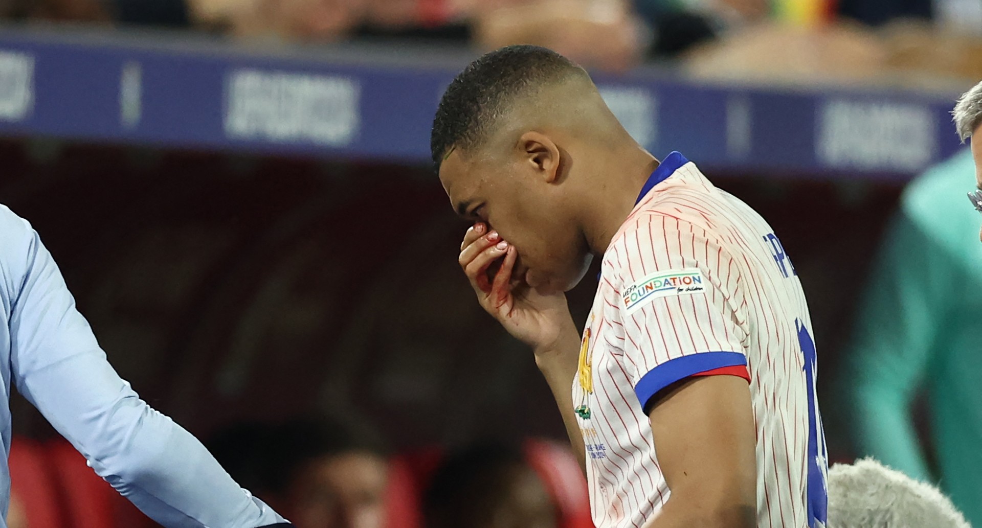 Kylian Mbappé prêt à être opéré d'un nez cassé